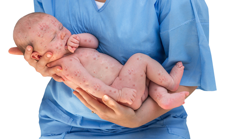 Uma complicação da rubéola é a inflamação do cérebro. Foto: Thinkstock uma criança com sementeira de pele nas mãos de um médico