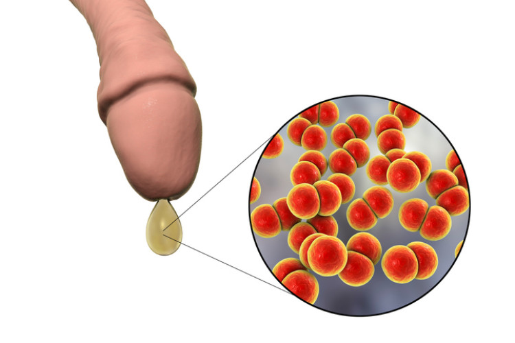 Gonorreia. Fonte: Getty Images achema do pénis com corrimento e bactérias microscópicas de gonorreia
