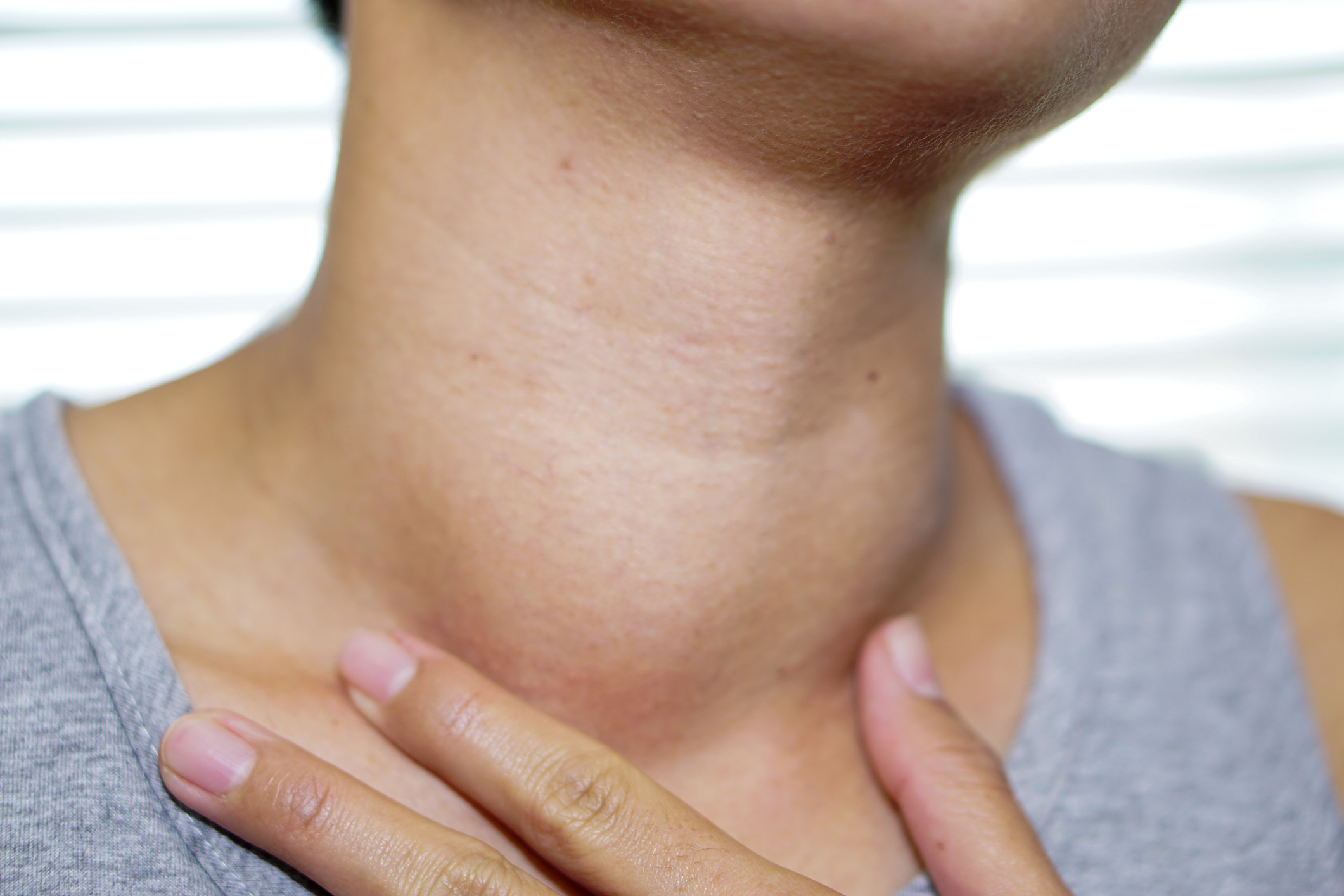 O aumento visível da glândula tiroide, chamado bócio, é uma consequência muito comum da ingestão insuficiente de iodo na dieta: Getty Images O aumento visível da glândula tiroide, chamado bócio, é uma consequência muito comum da ingestão insuficiente de iodo na alimentação.