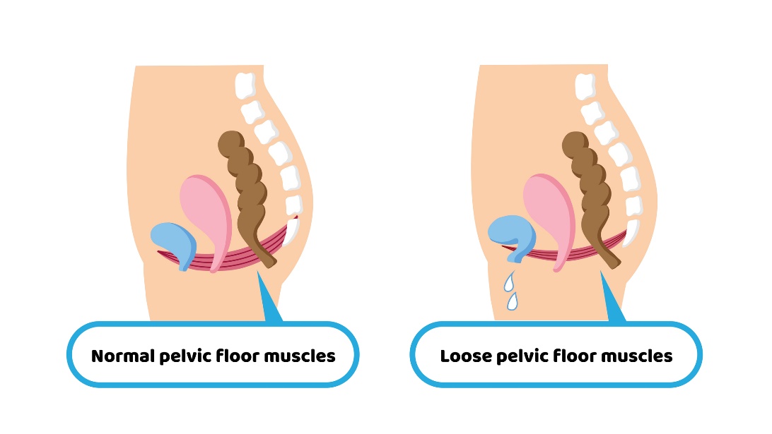 Condição fisiológica dos músculos do pavimento pélvico e condição enfraquecida dos músculos do pavimento pélvico que resulta em incontinência: Getty Images Condição fisiológica da musculatura do pavimento pélvico e condição permissiva da musculatura do pavimento pélvico que resulta em incontinência