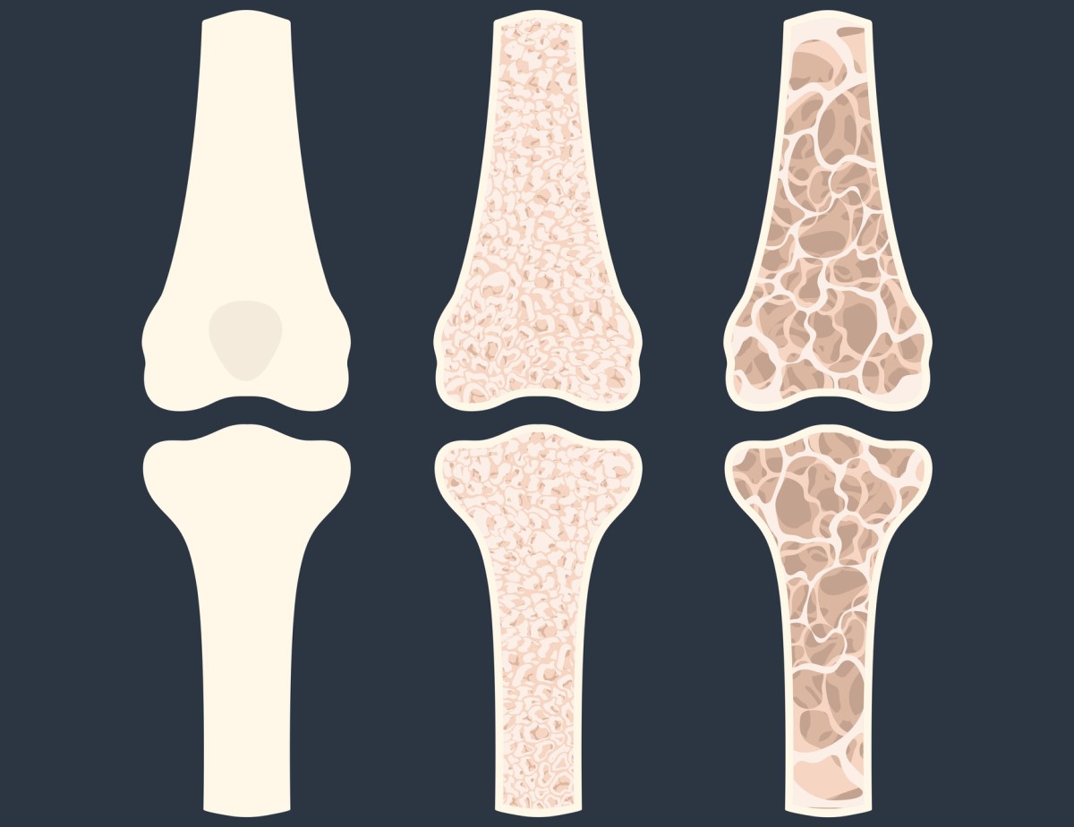 A consequência mais grave da hipocalcemia é o desenvolvimento de osteopenia e osteoporose, que se manifestam por uma perda óssea significativa: Getty Images Animação de três ossos mostrando osteoporose - afinamento dos ossos