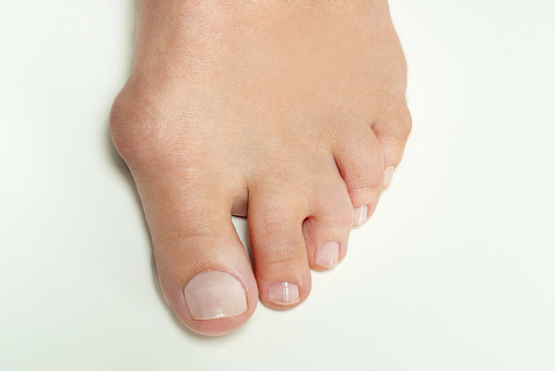 Hallux valgus. Fonte: Getty Images pé com joanete