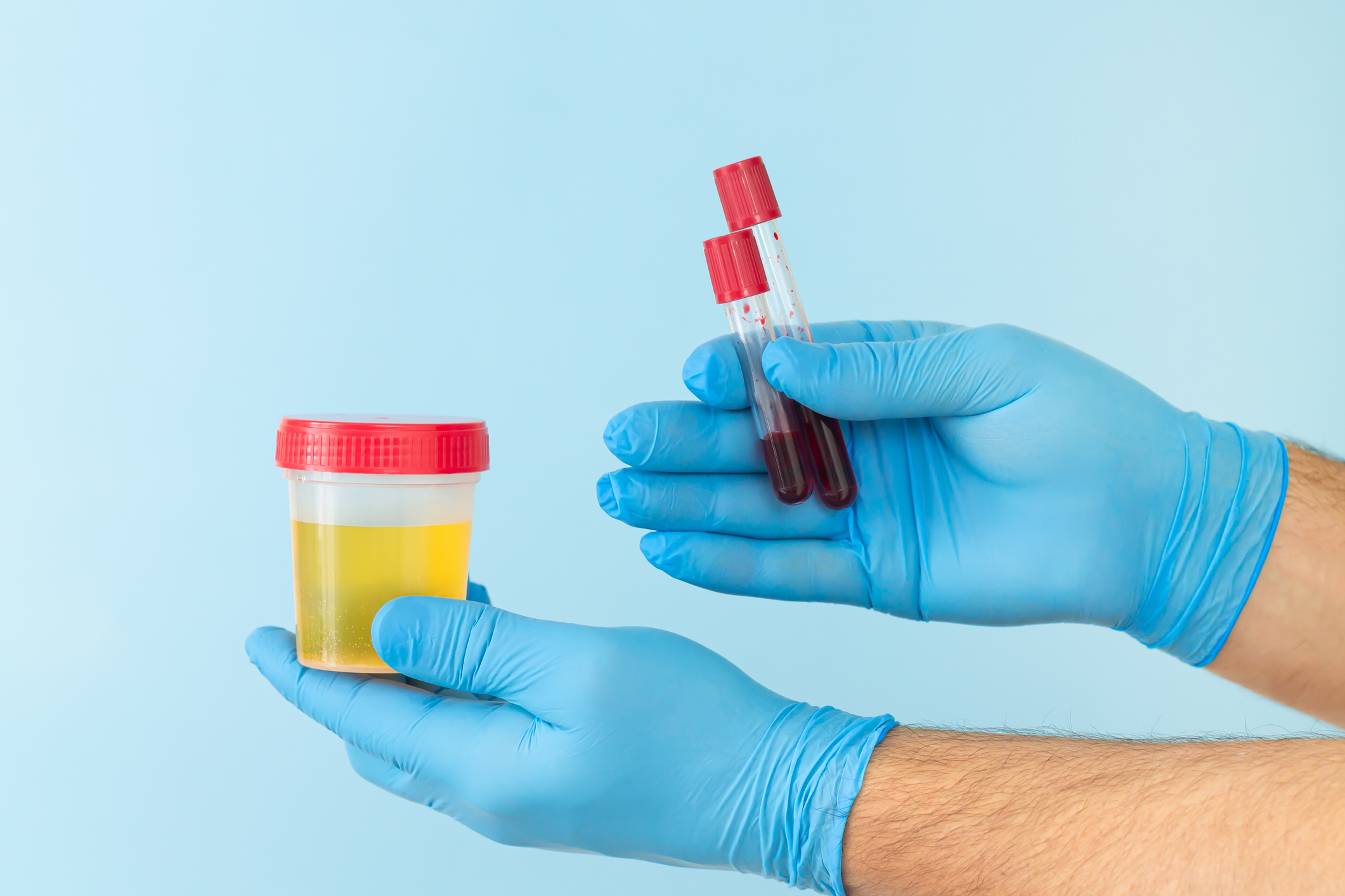 Os desvios dos níveis fisiológicos de cloreto no sangue ou na urina são detectados através de testes laboratoriais: Getty Images Os desvios dos níveis fisiológicos de cloreto no sangue ou na urina são detectados por testes laboratoriais.