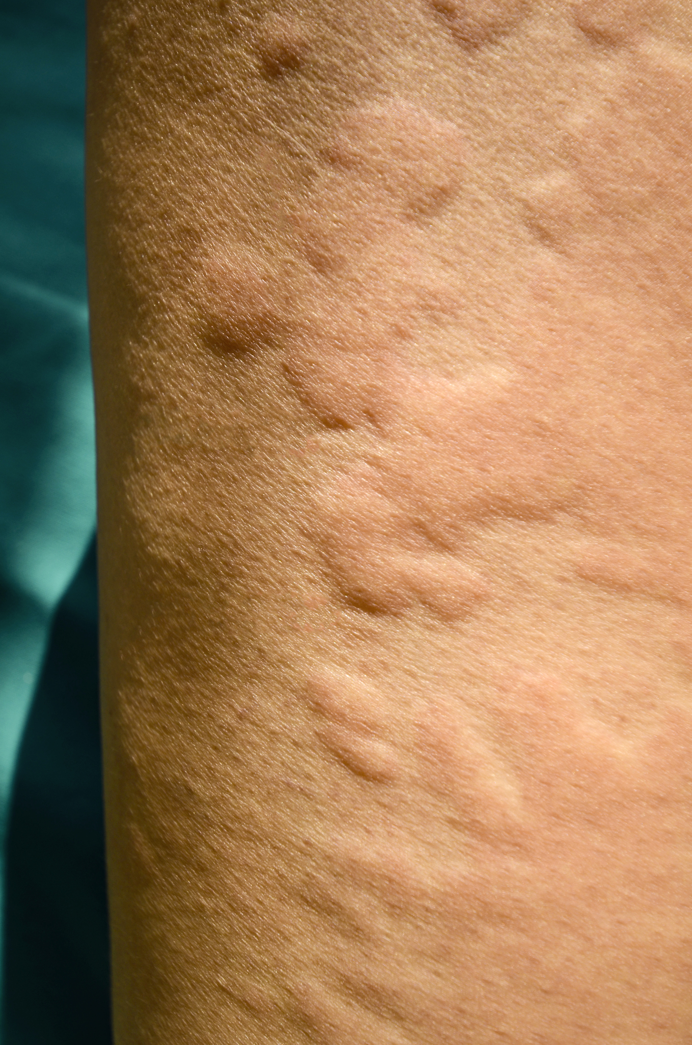 Foto: Thinkstock urticária eczema alérgico - pequenas borbulhas que sobressaem acima do nível da pele