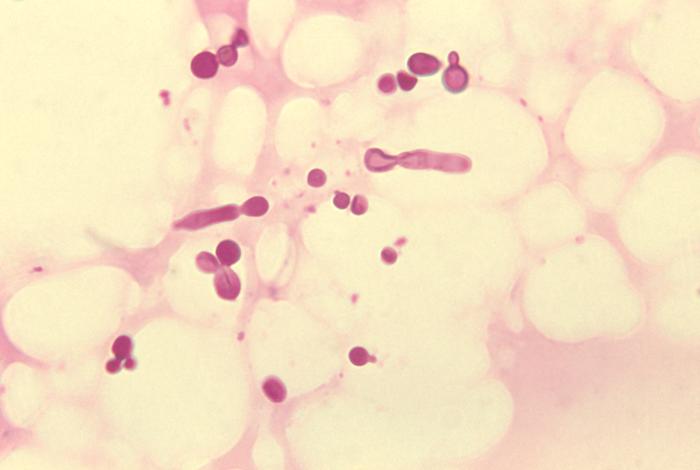 micose que provoca pitiríase versicolor