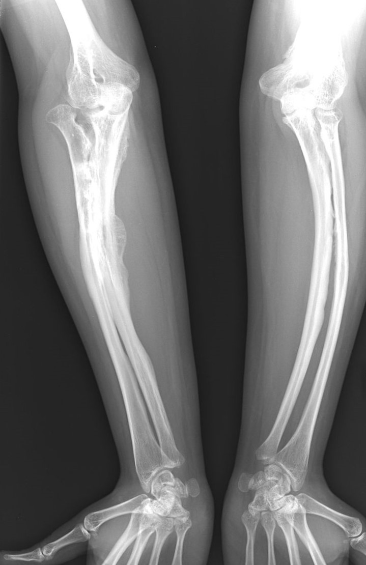 Osteogénese imperfeita num adulto Foto do autor: ShakataGaNai Radiografias da doença osteogénese imperfeita num adulto
