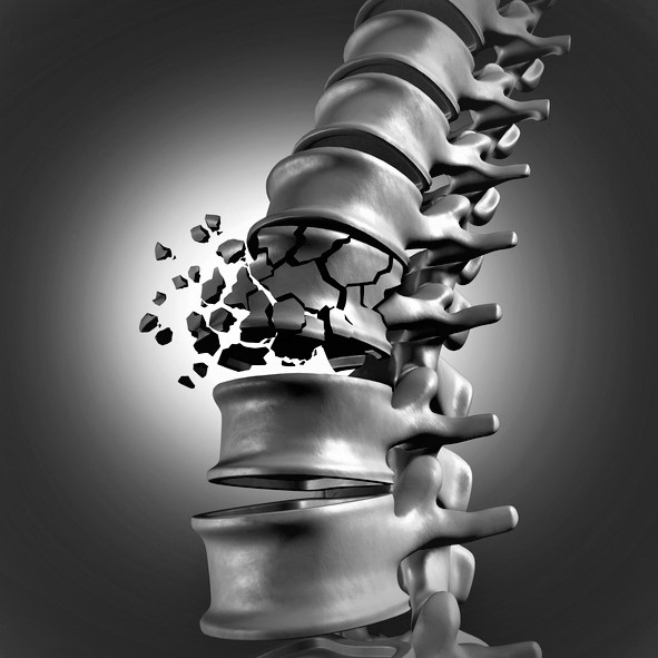 Uma fratura vertebral pode ocorrer mesmo quando se está sentado de forma brusca. Fonte da foto: Getty Images Fratura vertebral da coluna vertebral