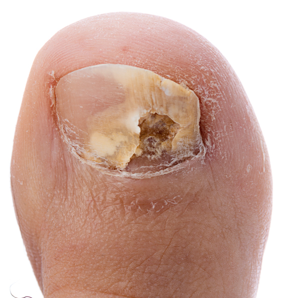 Tinea unguium ou também onicomicose, ou seja, micose da unha: Getty Images Tinha ungueal ou micose fungóide