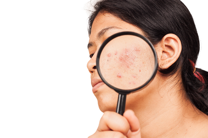 mulher com lupa na cara tem acne