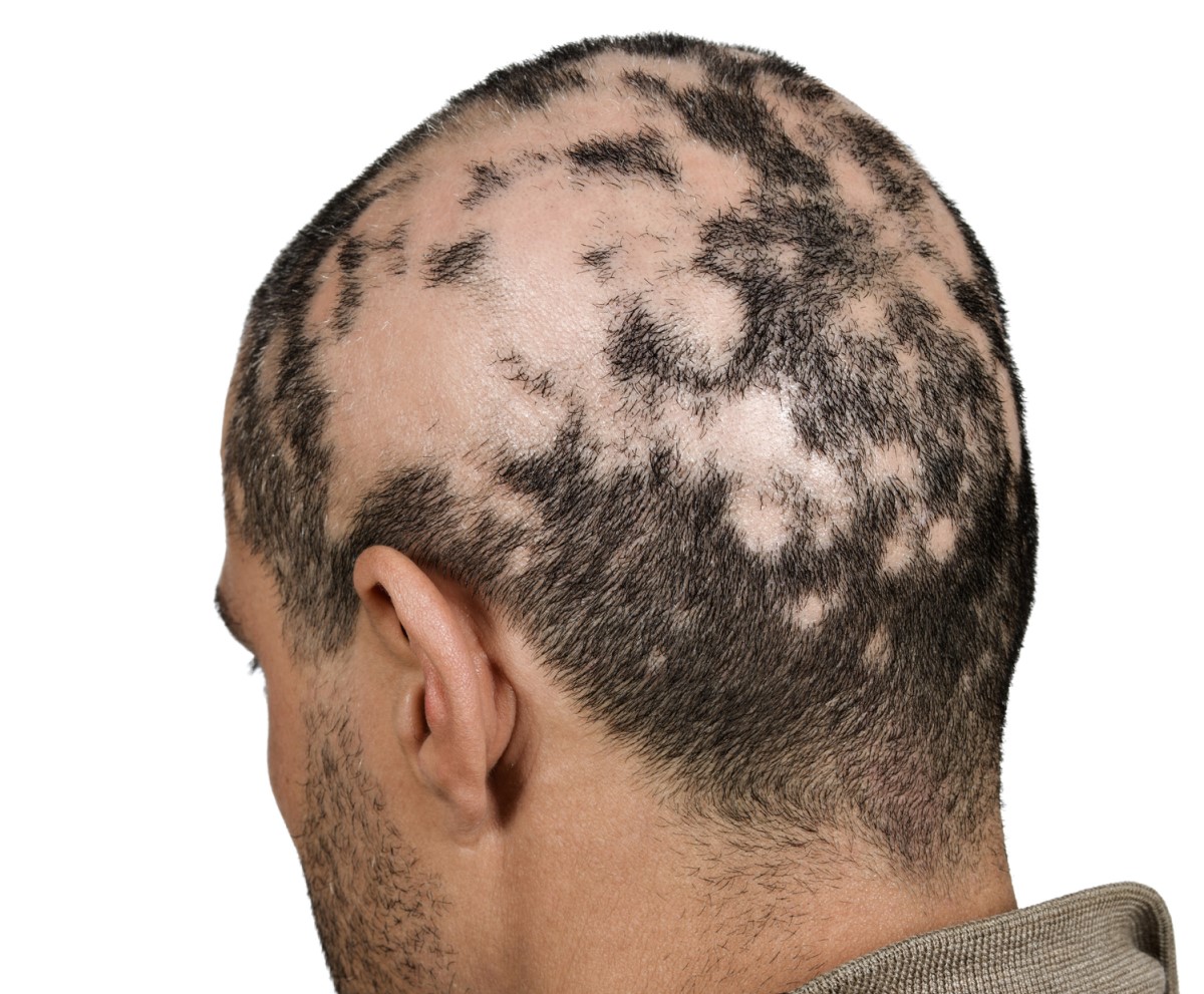 Queda de cabelo excessiva sob a forma de ilhotas - alopecia areata. Fonte da foto: Getty Images Cabeça masculina - queda de cabelo - queda de cabelo excessiva sob a forma de ilhotas - alopecia areata