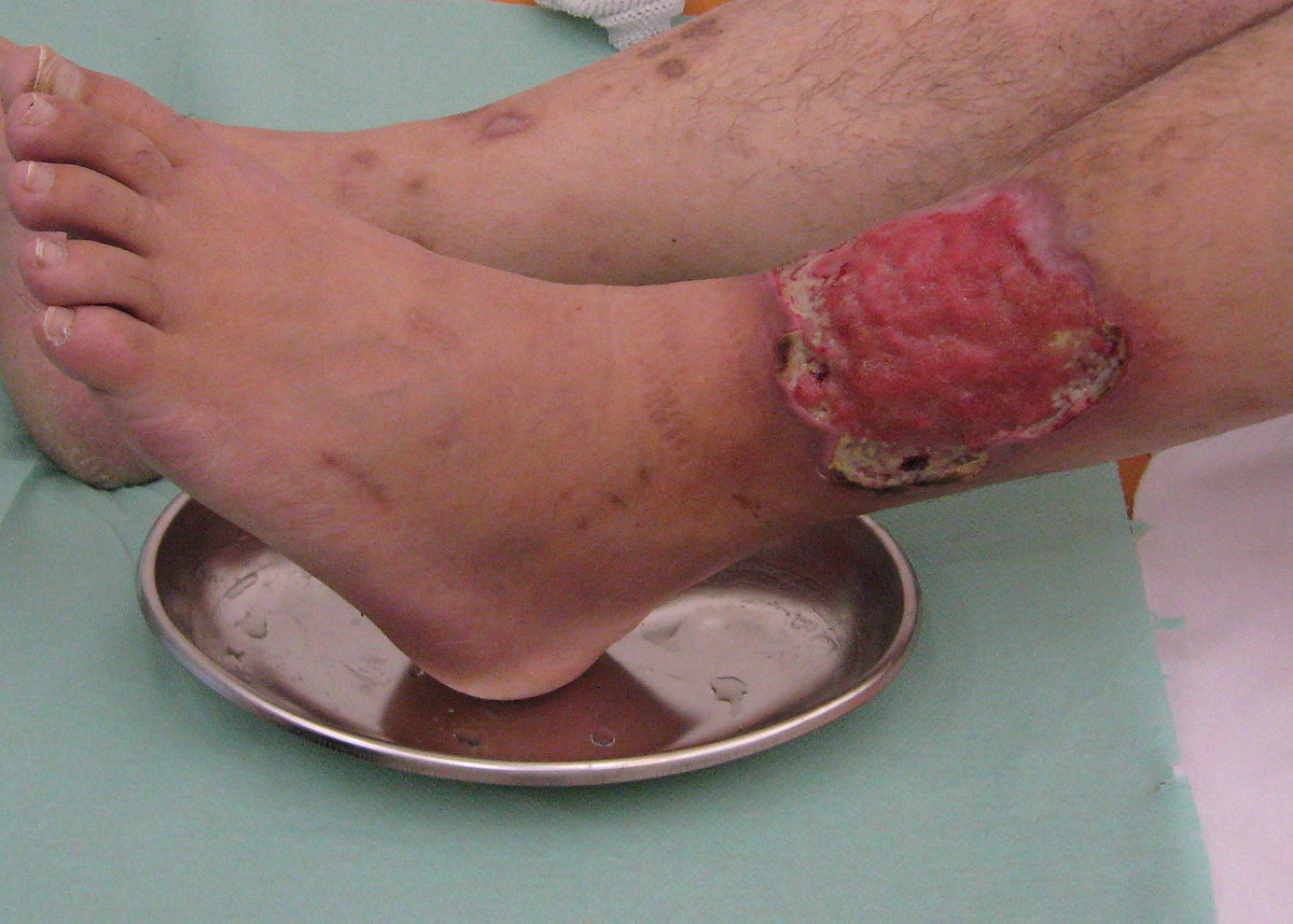 Úlcera tibial em cicatrização, granulação ao longo dos bordos da ferida. Foto: Thinkstock photos Úlcera tibial em cicatrização, cicatrização por granulação à volta dos bordos da ferida, úlcera acima do tornozelo no exterior do membro inferior