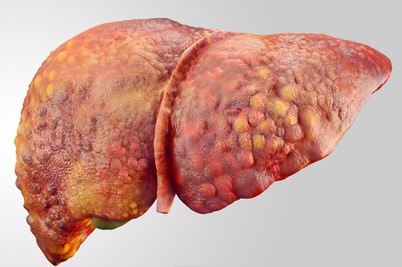 Urina escura mesmo nas lesões hepáticas, na cirrose. Fonte da foto: Thinkstock Photos Fígado danificado por cirrose, função hepática comprometida, urina escura como consequência