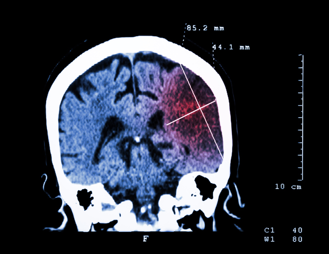 Lesão cerebral visível na TAC