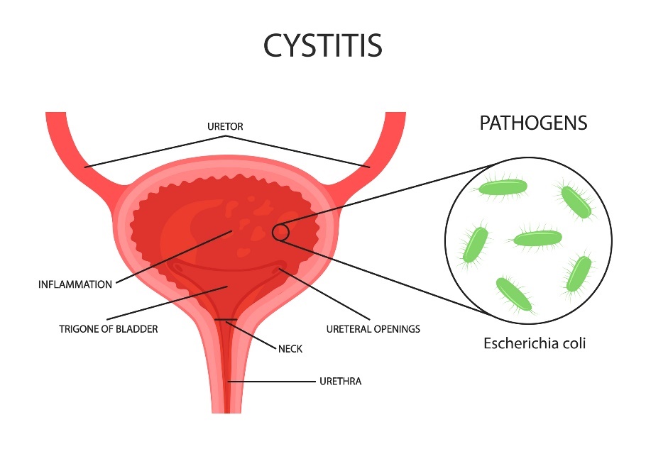 Cistite (infecção da bexiga e do tracto urinário): a bactéria causadora é a Escherichia coli. Uteror (ureter), uretra: Getty Images Inflamação da bexiga