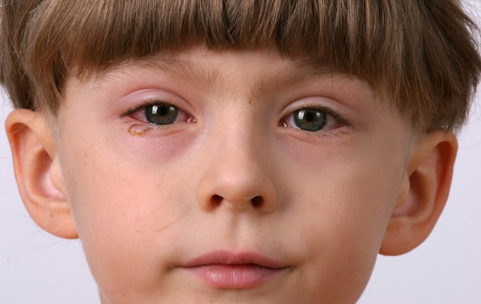 Os sintomas são associados de acordo com a causa desencadeante, sendo um exemplo a inflamação. Fonte da foto: Getty Images A criança tem um olho inflamado, vermelho e inchado