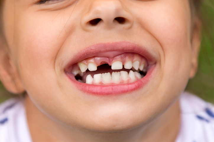 A substituição dos dentes de leite na infância é um fenómeno natural: Getty Images O bebé tem um bebé, dente de leite, primeiro dente a cair, sorriso
