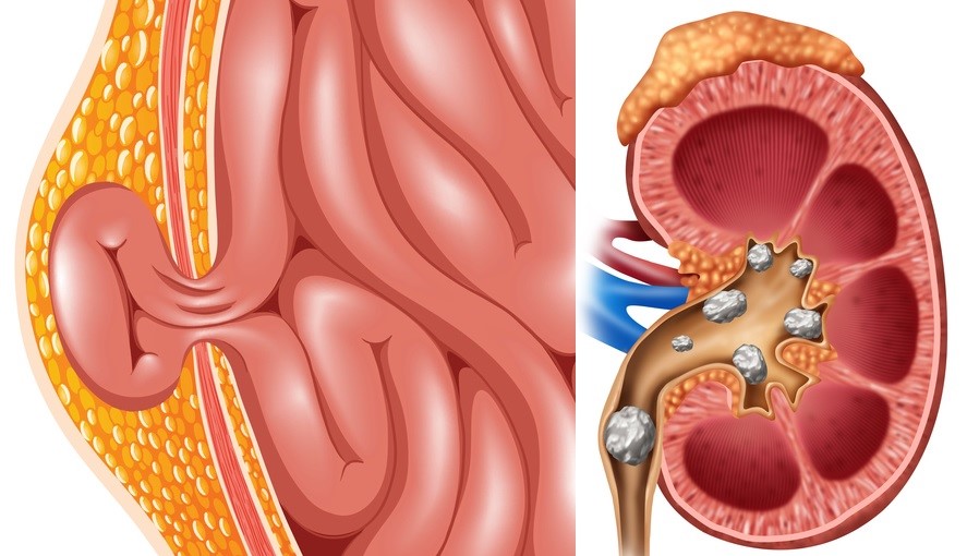 As hérnias no escroto, mas também os cálculos urinários são uma causa de dificuldades. Fonte: thinkstock photos Hérnia, cálculos renais e urinários