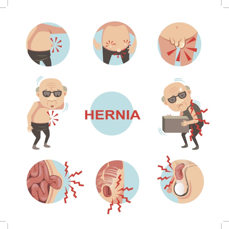 Fonte: Getty Images Infografia sobre hérnia