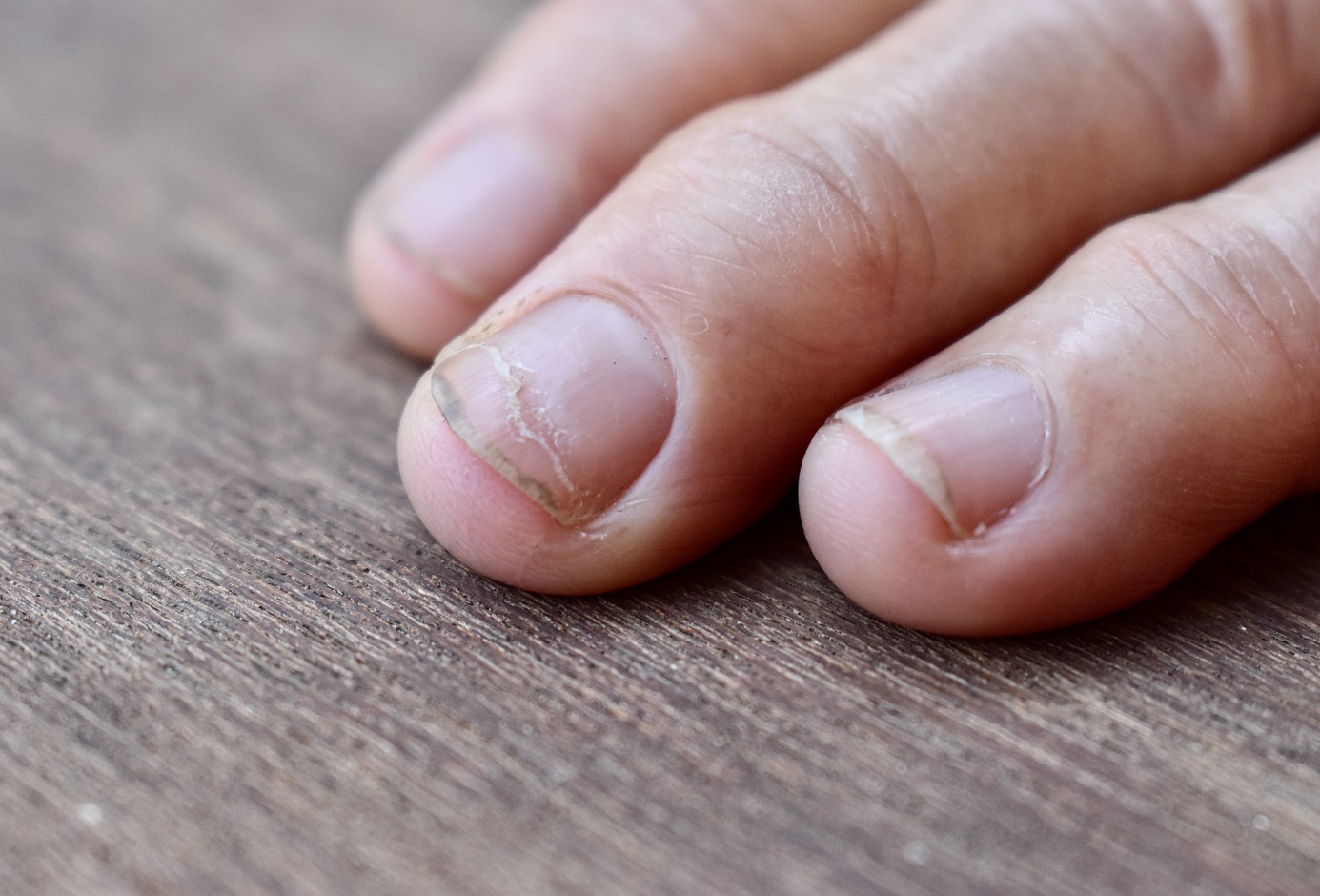 Ranhuras horizontais para pregos Fonte: Getty Images Ranhuras horizontais nas unhas - mão, dedos, unhas