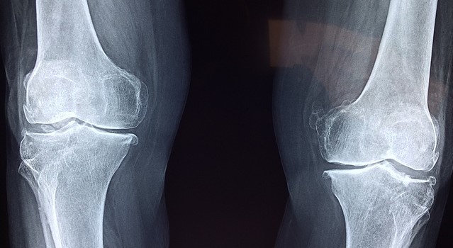 Danifica as articulações: Getty Images Radiografia das articulações do joelho