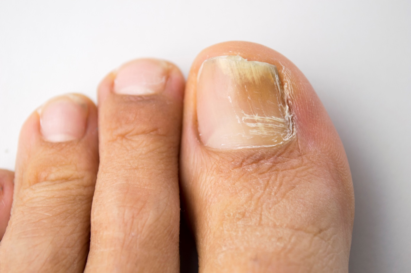 Unhas quebradiças e fragilidade visível das unhas nos membros inferiores e nos pés.