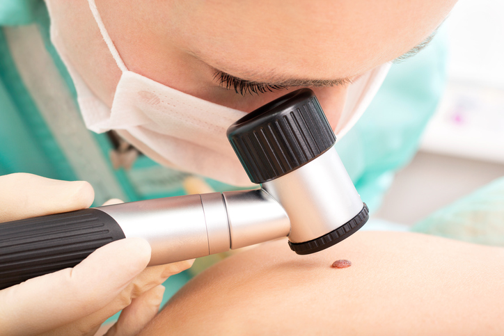 Um médico observa toupeiras utilizando um dermatoscópio. Fonte da foto: Getty Images o médico examina o sinal cutâneo com um dermatoscópio
