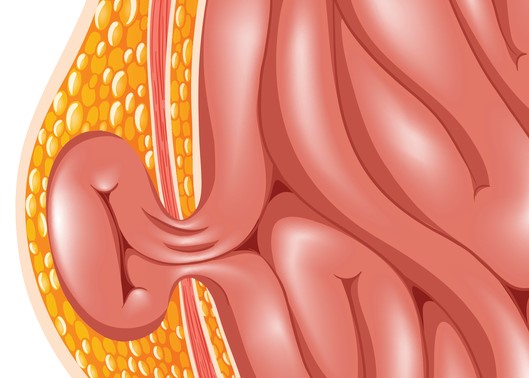 Hernie. Fonte: Getty Images Modelo de hérnia, ou seja, hérnia da parede abdominal