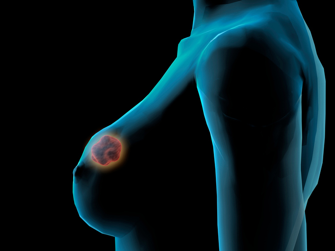 O cancro da mama metastatiza frequentemente para os ossos: Getty Images Modelo de tórax e peito feminino, cancro da mama