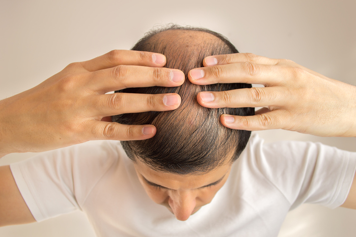 Alopécia. Foto: Thinkstock photos Homem com cabelo escasso, queda de cabelo, calvície ou alopecia, mãos na cabeça, vista de cima