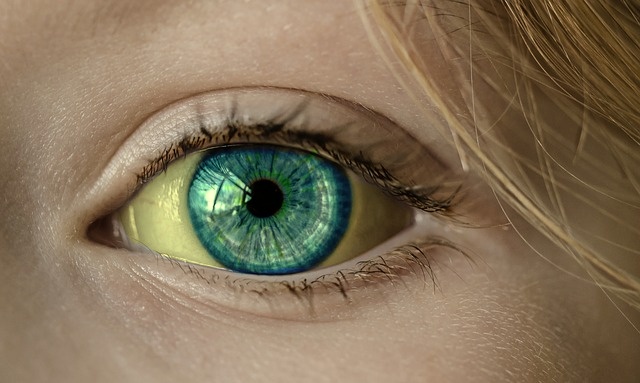 Brancos dos olhos de cor amarela Fonte da fotografia: Getty Images Brancos dos olhos amarelos em iterícia, iterícia, excisão, pormenor do olho