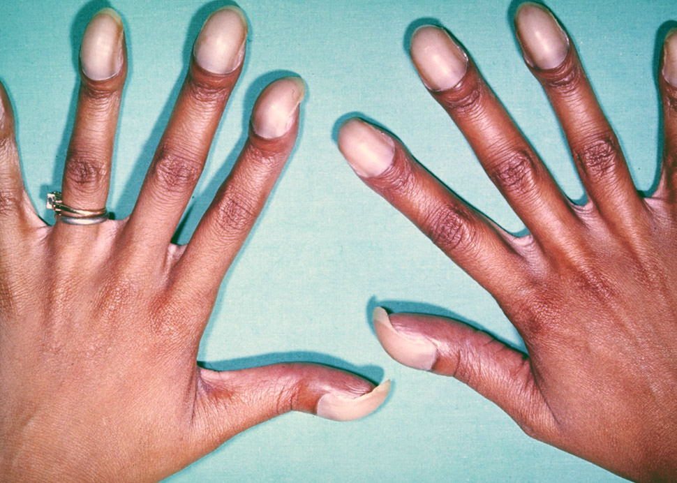 Um sintoma da doença da tetralogia de Fallot Fotografia de Herbert L. Fred, MD e Hendrik A. van Dijk Uma mulher tem dedos atarracados como sintoma de doença, e esta tetralogia de Fallot