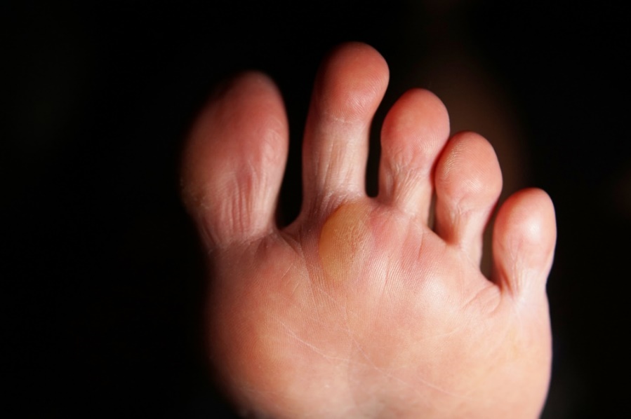Uma bolha no pé causada por fricção mecânica. Fonte: Getty Images Bolhas no pé