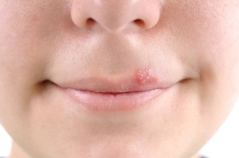 Bolhas - herpes (herpes labial) à volta do revestimento da boca Fonte: Getty Images Bolhas - herpes labial (herpes) à volta da mucosa da boca.