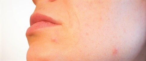 Puberdade, gravidez, menopausa, aumento da lubrificação da pele, acne, erupções cutâneas. Fonte da foto: Getty Images Rosto feminino, recorte, pormenor na pele do queixo, erupções cutâneas, acne resultante de pele oleosa
