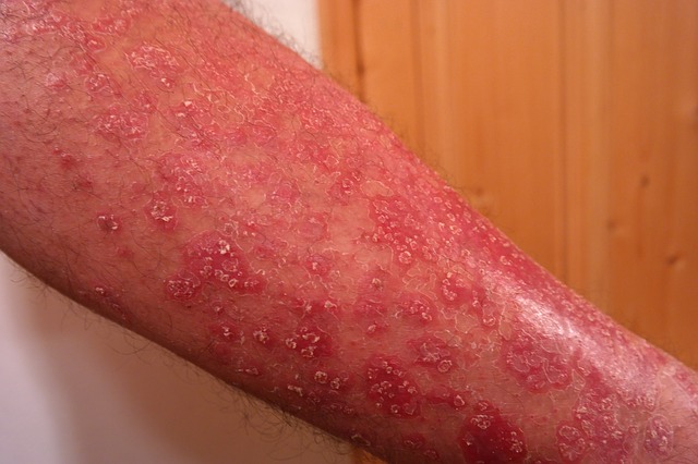 A causa pode ser a psoríase. Foto: Thinkstock photos Psoríase nos antebraços, pele escamosa e avermelhada, com perda de pêlos
