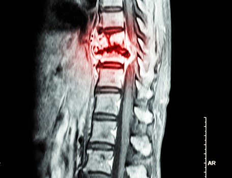 Cancro nas vértebras da coluna torácica: Getty Images Radiografia da coluna vertebral torácica com evidência de cancro na coluna vertebral torácica