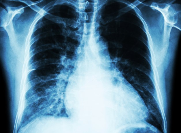 Radiografia: tórax com imagem do coração Fonte: Thinkstock photos Radiografia do tórax, coração - ampliação