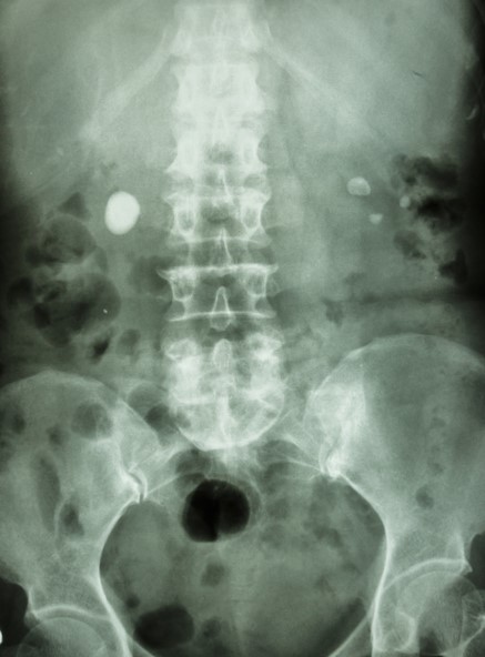 Pedras nos rins numa imagem de raio-X. Fonte da foto: Thinkstock Photos Radiografia do abdómen, cálculos renais de ambos os lados, em ambos os rins