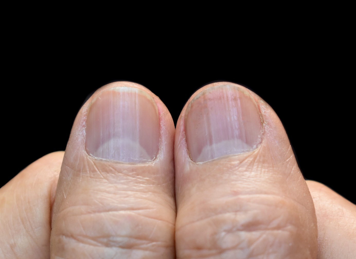As estrias nas unhas indicam uma possível doença não diagnosticada: Getty Images Linha das unhas, mão, dedos, unhas