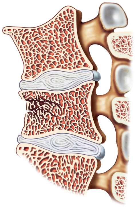 coluna vertebral, representação das vértebras e dos discos intervertebrais, fratura vertebral