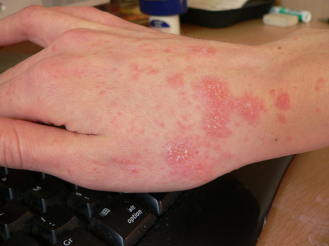 sarna nas mãos, vermelhidão, doenças infecciosas da pele