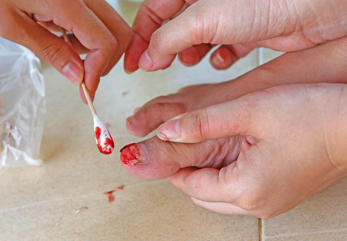 Danos no prego num acidente Fonte: Getty Images Danos nas unhas devido a ferimentos, hemorragias, tratamento com um cotonete