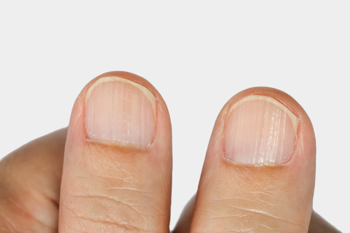 Ranhuras verticais nas unhas Fonte: Getty Images Ranhuras verticais nas unhas - dedo, unha e ranhuras