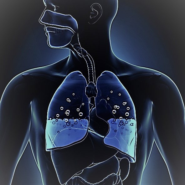 Com edema pulmonar grave, ouve-se gorgolejo e rouquidão. Fonte da foto: Getty Images Representação esquemática dos pulmões com inchaço, água no meio dos pulmões, vias respiratórias