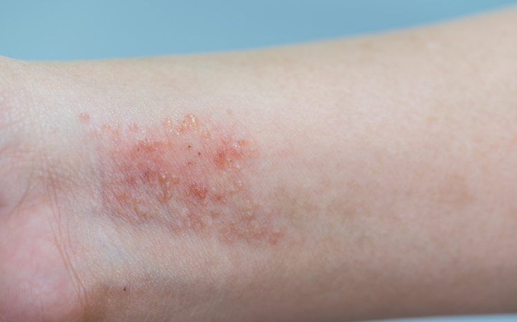 Eczema alérgico (de contacto) no pulso Foto: Thinkstock photos Eczema nos pulsos e antebraços, inflamação da pele inchada e avermelhada, como a dermatite de contacto