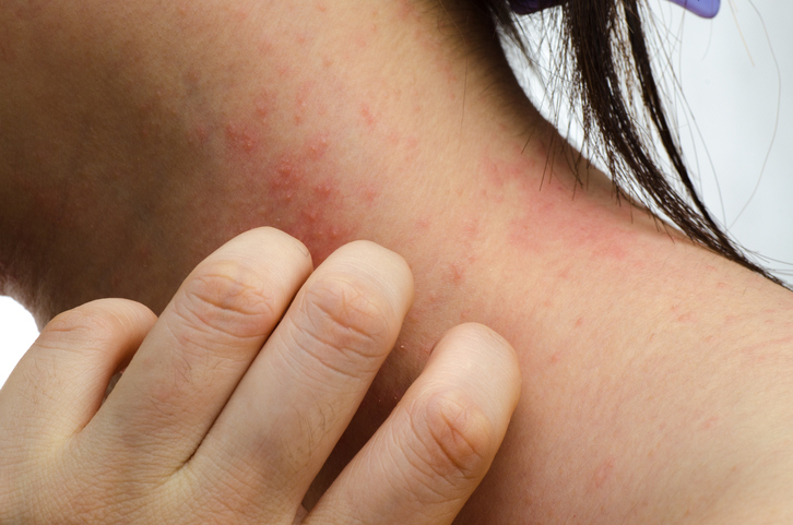 A comichão e o coçar são um risco de infeção bacteriana. Foto: Thinkstock photos Uma mulher coça o pescoço, com comichão, inflamação da pele, vermelhidão e erupções cutâneas no pescoço