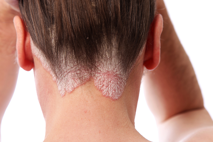 Psoríase na parte cabeluda da cabeça. Fonte da foto: Thinkstock photos uma mulher tem psoríase na parte cabeluda da cabeça, parte da cabeça da cabeça
