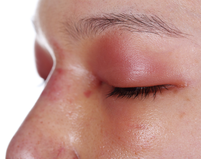 O inchaço das pálpebras é acompanhado de vermelhidão na inflamação. foto de origem: Getty Images os olhos da mulher estão inflamados, vermelhos e inchados