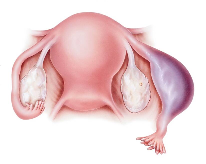 O desenvolvimento e crescimento do óvulo fertilizado na trompa de Falópio, ameaçando a sua rutura e subsequente hemorragia: Getty Images