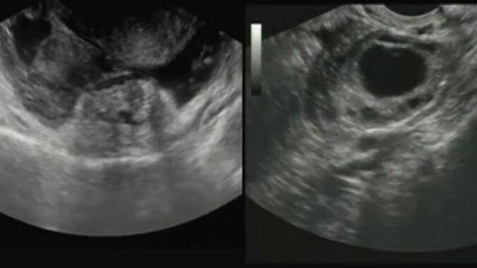 A ecografia abdominal é importante para confirmar o diagnóstico: Getty Images